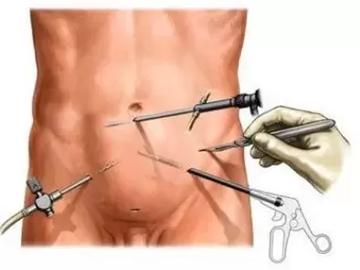 krónikus prosztatagyulladás sebészeti kezelése