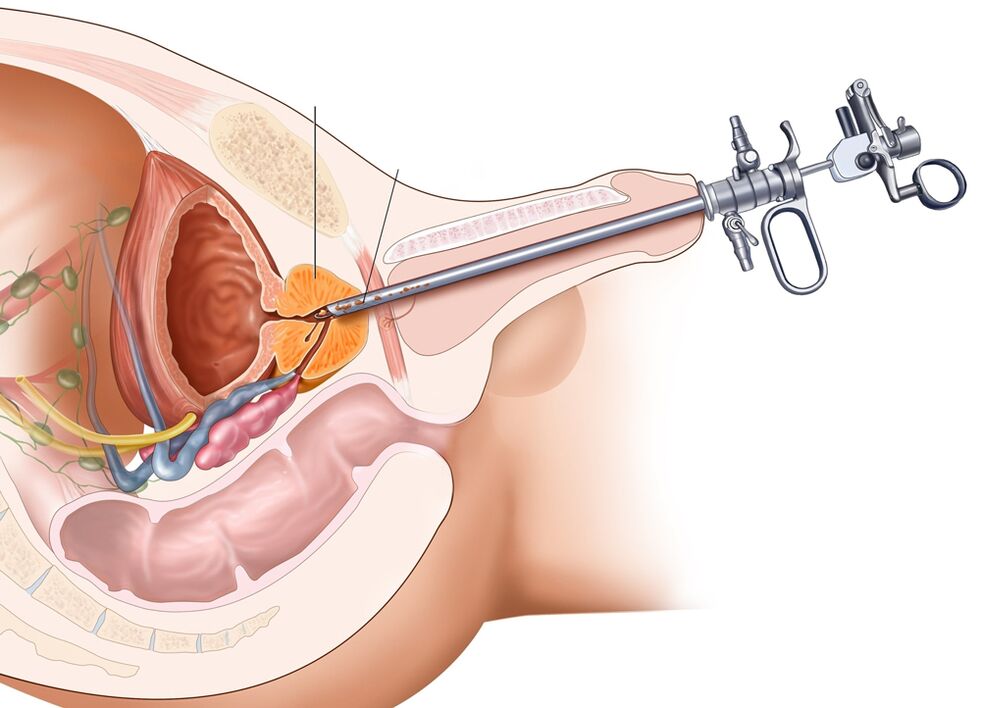 A prosztata transzuretrális reszekciója lehetővé teszi a szerv érintett részeinek eltávolítását