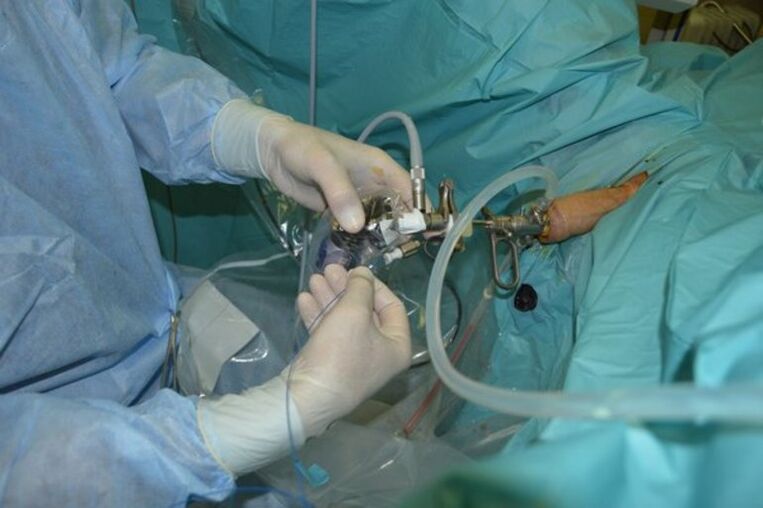 A prosztata transzuretrális reszekciója a szerv egy részének eltávolítására krónikus prosztatagyulladásban